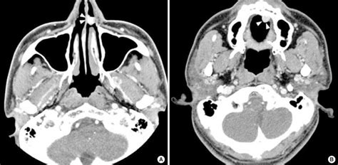 Contrast Enhanced Neck Axial Computed Tomography Ct Finding A Ct Download Scientific