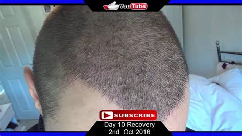 Fue Hair Transplant Day 10 Post Op Recovery Youtube