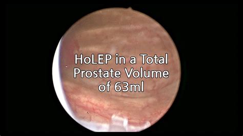 Routine Holep Procedure With Dr Oh 63ml Youtube