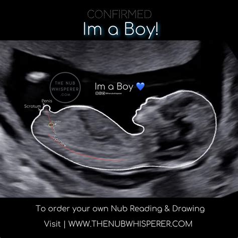 Baby Boy Using Nub Theory Ultrasound Gender Gender Prediction Nub