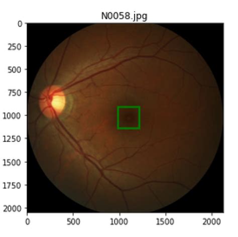 Fovea Localization For Age Related Macular Degeneration Amd And Non