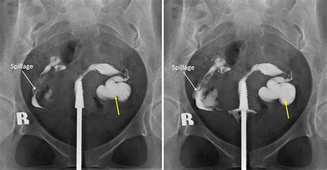 Hydrosalpinx – Radiology Cases