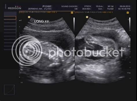 Pregnancy ultrasound boy or girl | XXX Porn Library