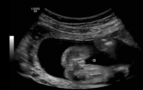 21 week ultrasound. Boy or Girl guesses? | BabyCenter