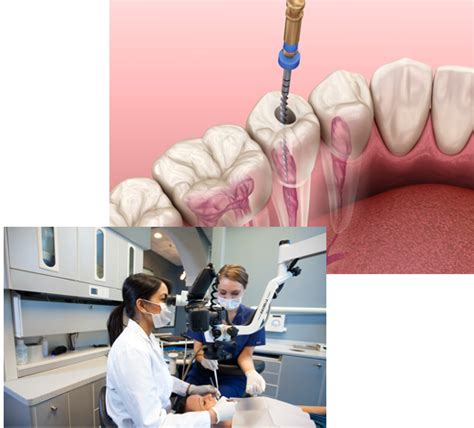 Queens Root Canal Dental Clinic Root Canal Treatment Etobicoke Root Canal Help Etobicoke