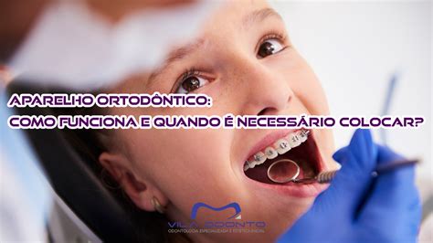 Lente De Contato Dental Como Funciona E Quando Colocar Vila Odonto