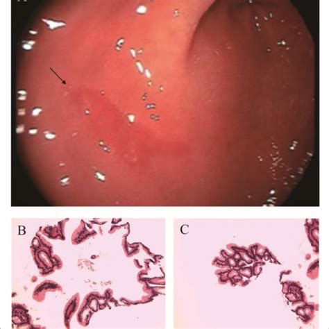 A Electronic Gastroscopy Bc Gastric Antrum Pathology Download Scientific Diagram