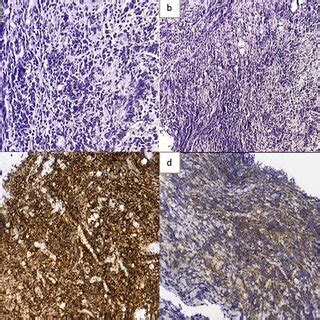 Histological Examination Of The Specimen Showed A Diffuse Proliferation