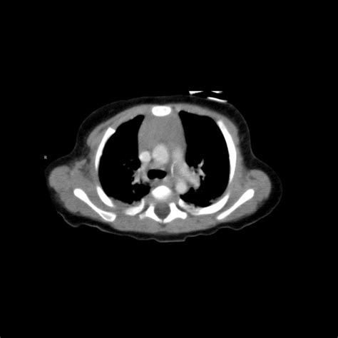 Ligamentum Arteriosum | Pediatric Radiology Reference Article ...