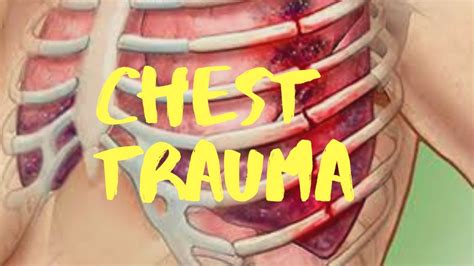 Lesson 9 Chest Trauma Youtube