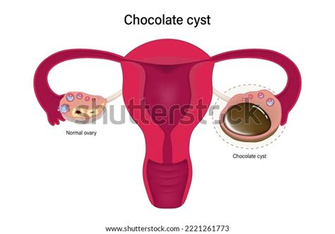 Chocolate Cyst Female Ovarian Disease Vector Stock Vector (Royalty Free ...