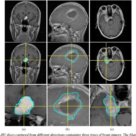 Figure 1 From Brain Tumor Classification By Cascaded Multiscale