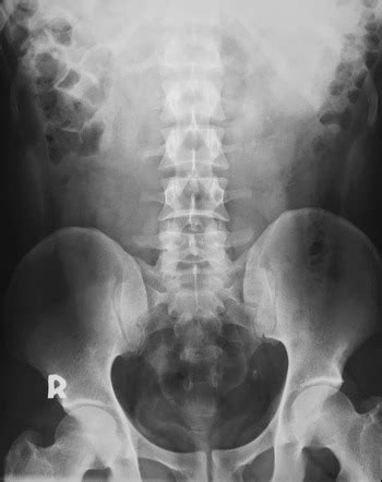 Ureteric stone | Radiology Case | Radiopaedia.org