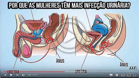 Infecci N Urinaria De Repetici N Causas Y Prevenci N Imevictoria