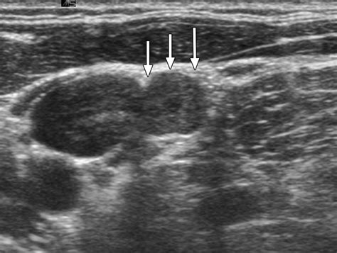 Thyroid Papillary Carcinoma Ultrasound