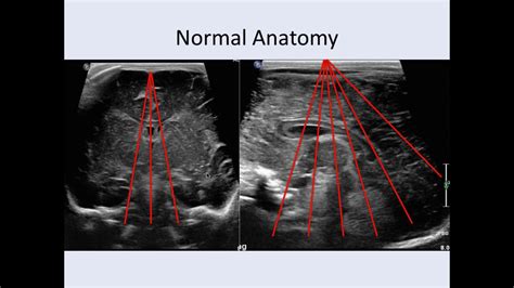 Neonatal Brain Ultrasound Anatomy