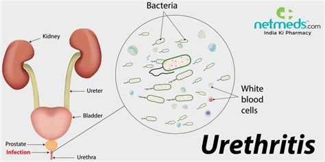 Urethritis: Causes, Symptoms And Treatment