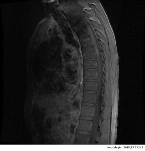 Parainfectious Longitudinally Extensive Transverse Myelitis Associated With Varicella Zoster