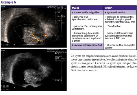 Imagerie Des Tumeurs Ovariennes Du B Nin Au Malin Les Signes Dappel