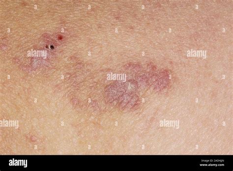 Model Released Lichen Planus Disease Close Up Of The Skin Of A 55