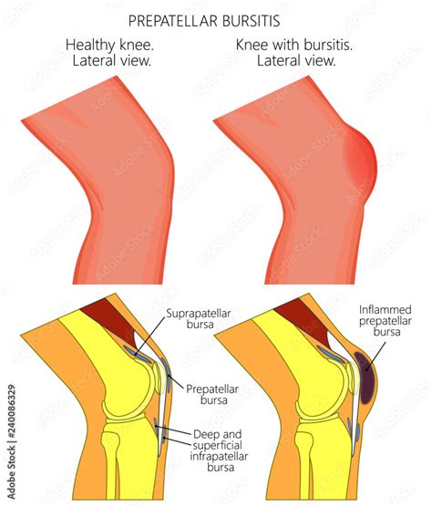 Vector Illustration Of A Healthy Knee And Unhealthy Knee With