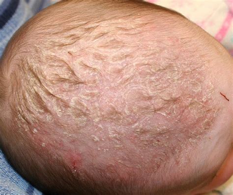 Scalp Psoriasis In Children Pictures