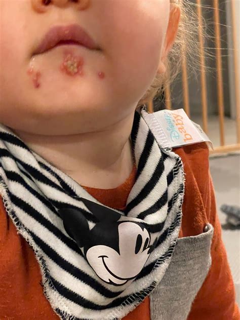 Was ist das für ein Ausschlag? - Kleinkind - Forum für Eltern zu