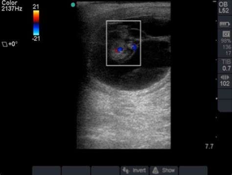 Ultrasonographic image of the presumed monozygotic twins at day 39 ...