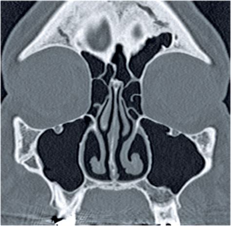 Scielo Brasil Sinus Computed Tomography Findings In Patients With