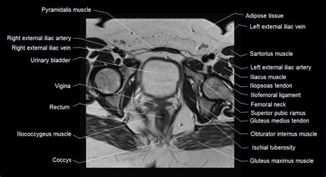 Female Pelvis Anatomy Free Axial Cross Sectional Anatomy Of Female Pelvis