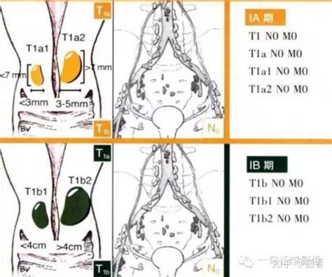 宫颈癌分期及图解 知乎