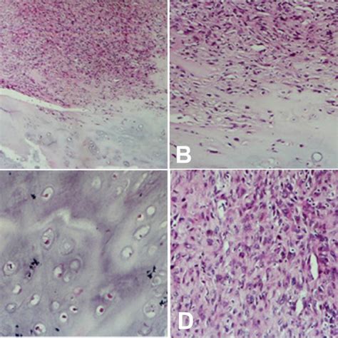 Histopathology Of Dedifferentiated Chondrosarcoma A B The Tumor Was Download Scientific