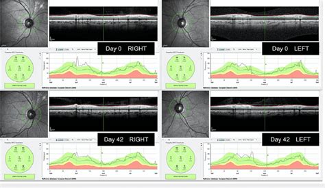 Pre-and post-treatment examination of the retinal nerve fiber layer ...