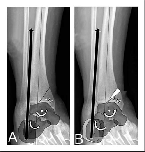 [PDF] Novel Double Osteotomy Technique of Distal Tibia for Correction of Asymmetric Varus ...