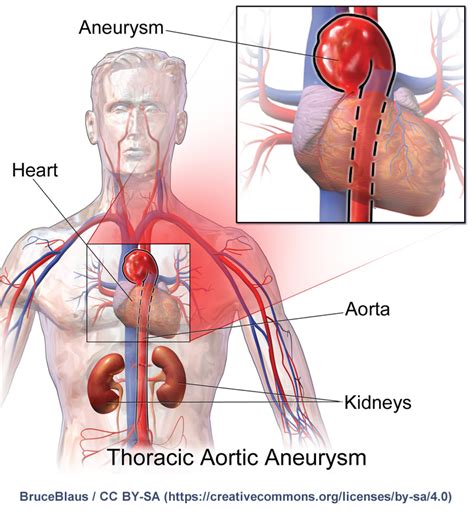 THORACIC AORTIC ANEURYSM (TAA)