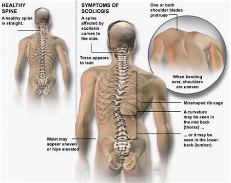 Scoliosis Spine Back Pain Chiropractic Treatment Vietnam