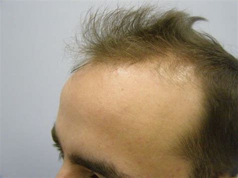 Hair Transplant Patient Gallery 20 Sure Hair Transplants Toronto Ontario Canada