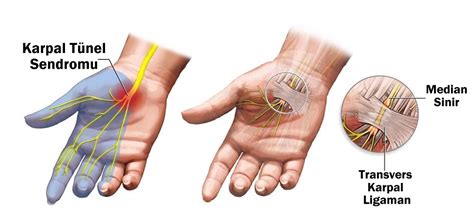 Karpal Tünel Sendromu nedir Nasıl tedavi edilir Prof Dr Levent