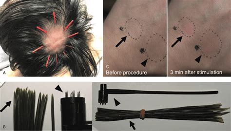 Acupuncture For Alopecia Areata A Filiform Needles With A Diameter