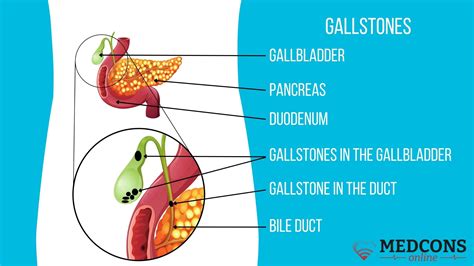 Gallstone Disease Symptoms Causes And Diagnosis At Different Stages