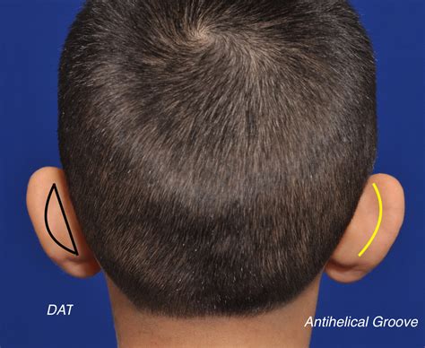 The Dermal Anchor Technique In Otoplasty For Protruding Ear Correction