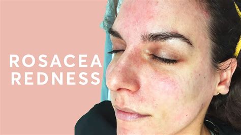 How To Treat A Red Face Rosacea Treatment Youtube