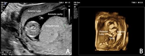 Early Sonographic Detection Of A Succenturiate Placenta After IVF In A