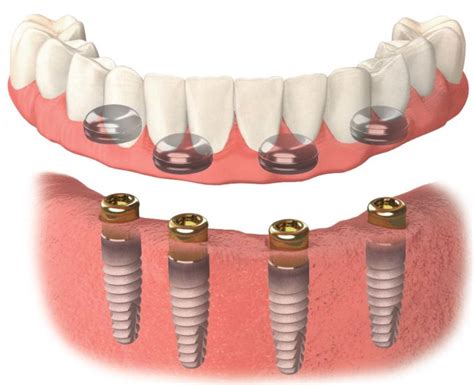 Pr Tesis Dentales Cl Nica Dental Alfonso Gonz Lez