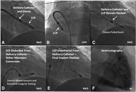 Permanent Leadless Cardiac Pacing Circulation