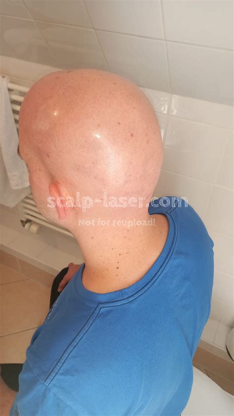 Basic Information About Scalp Laser Hair Removal Kopfhaare Weglasern