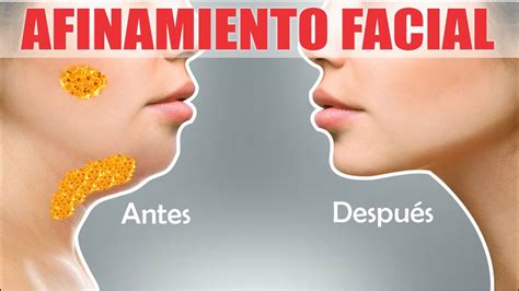 ADELGAZAR el ROSTRO con AFINAMIENTO FACIAL Lipopapada Bichectomía