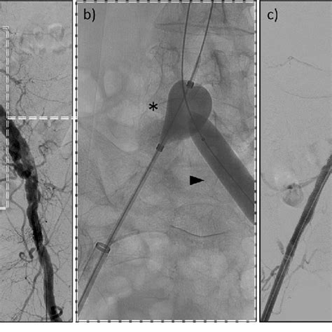 Example Of A Case With An Occlusion Of The Right Iliac Artery With Download Scientific Diagram