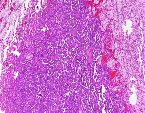 Papillary Renal Cell Carcinoma Global Pathology Teaching And