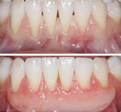 Gingival Graft Before And After